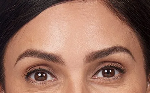 Forehead after Botox