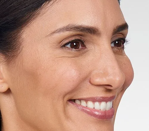 Side profile after Botox