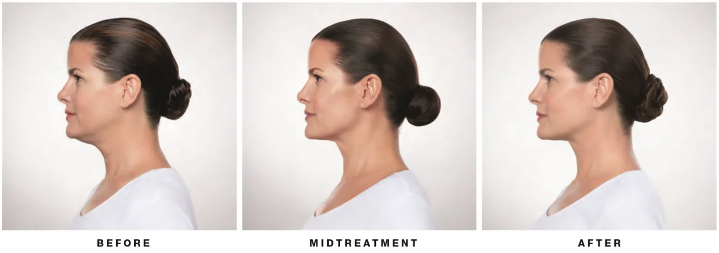 Before and after Kybella — side view