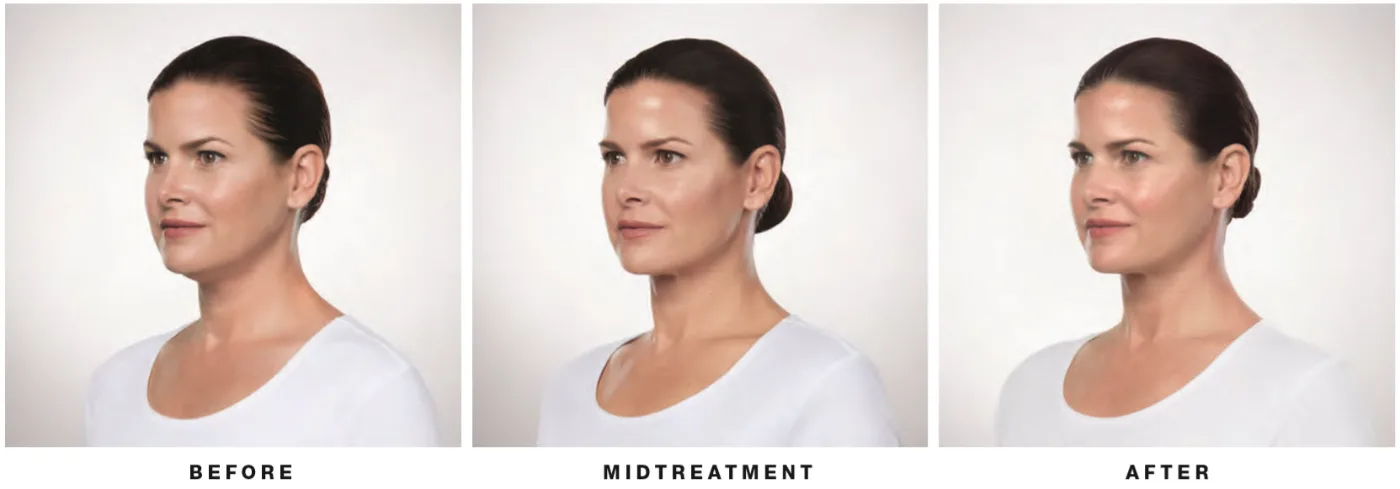 Before and after Kybella — partial side view