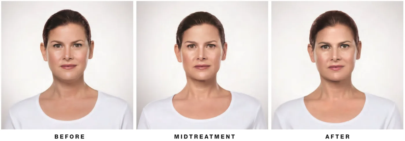 Before and after Kybella — front view