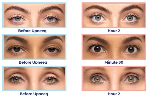 Before and after Upneeq treatment